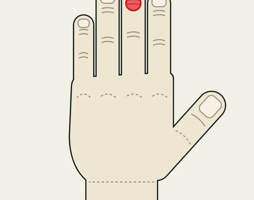 Mallet finger: lesión del extensor en el dorso de la articulación de la punta del dedo.