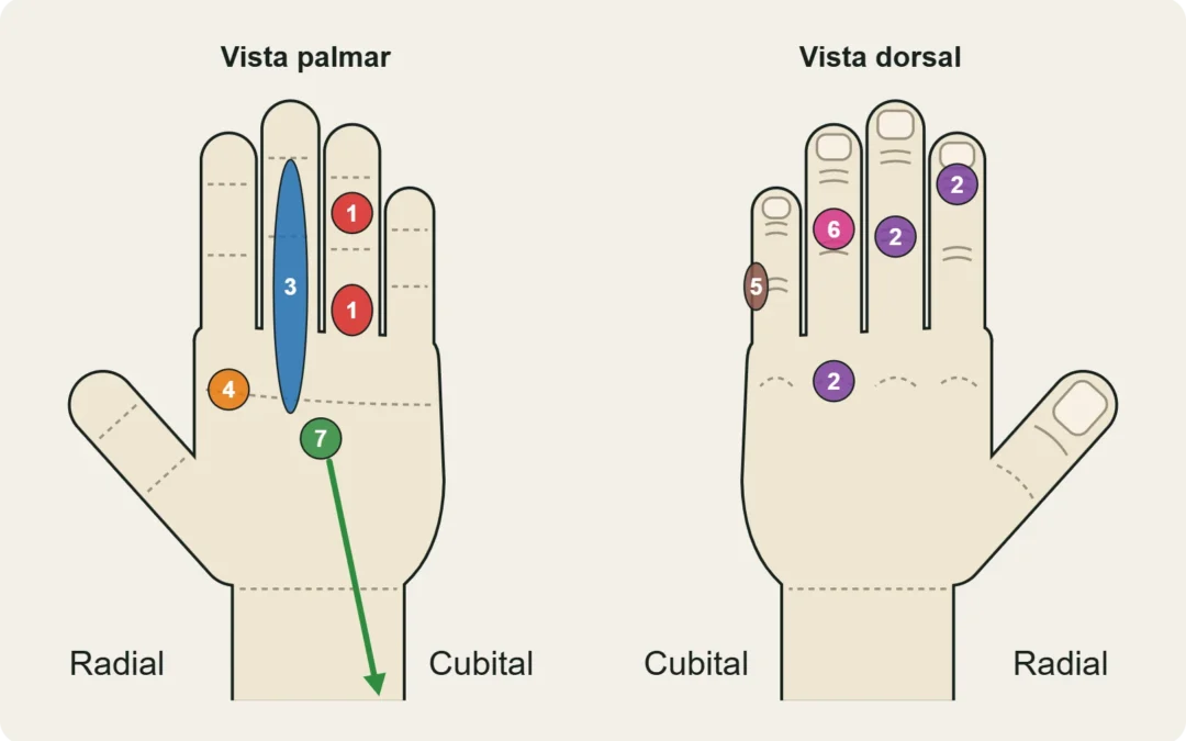 Mapa de las lesiones más frecuentes de los dedos del escalador (1–7), en vista palmar y dorsal.