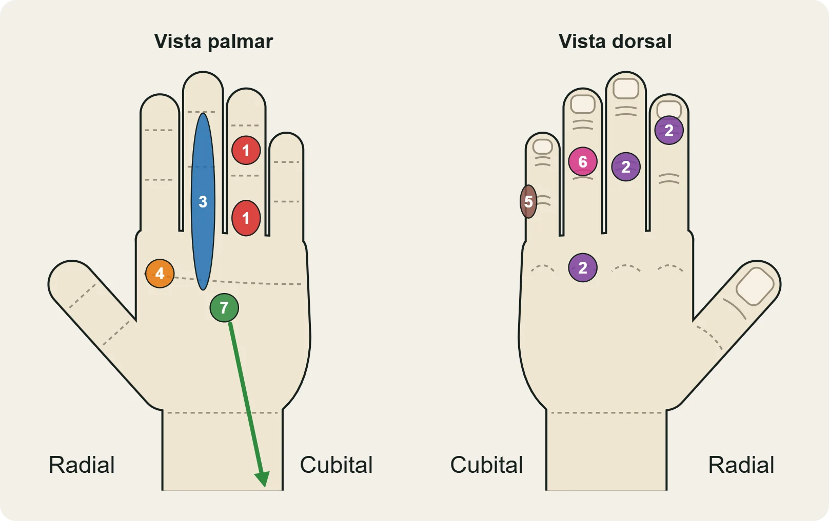 Mapa de las lesiones más frecuentes de los dedos del escalador (1–7), en vista palmar y dorsal.