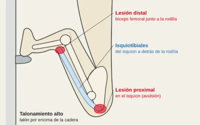 Rotura de isquiotibiales por talonamiento en escalada: de la sobrecarga a la avulsión