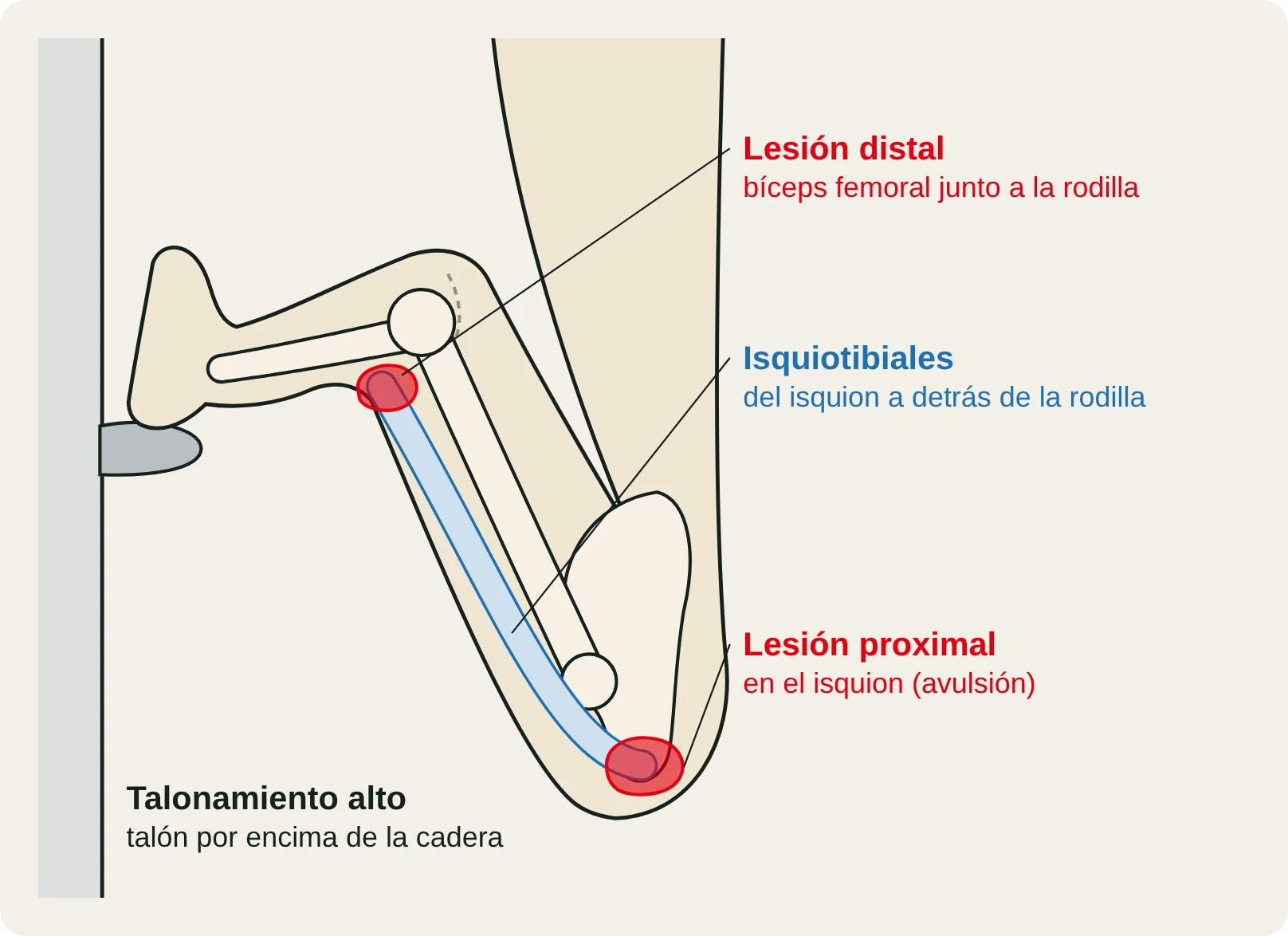 Esquema de un talonamiento alto con los isquiotibiales y las dos zonas de lesión: proximal (isquion) y distal (bíceps femoral).