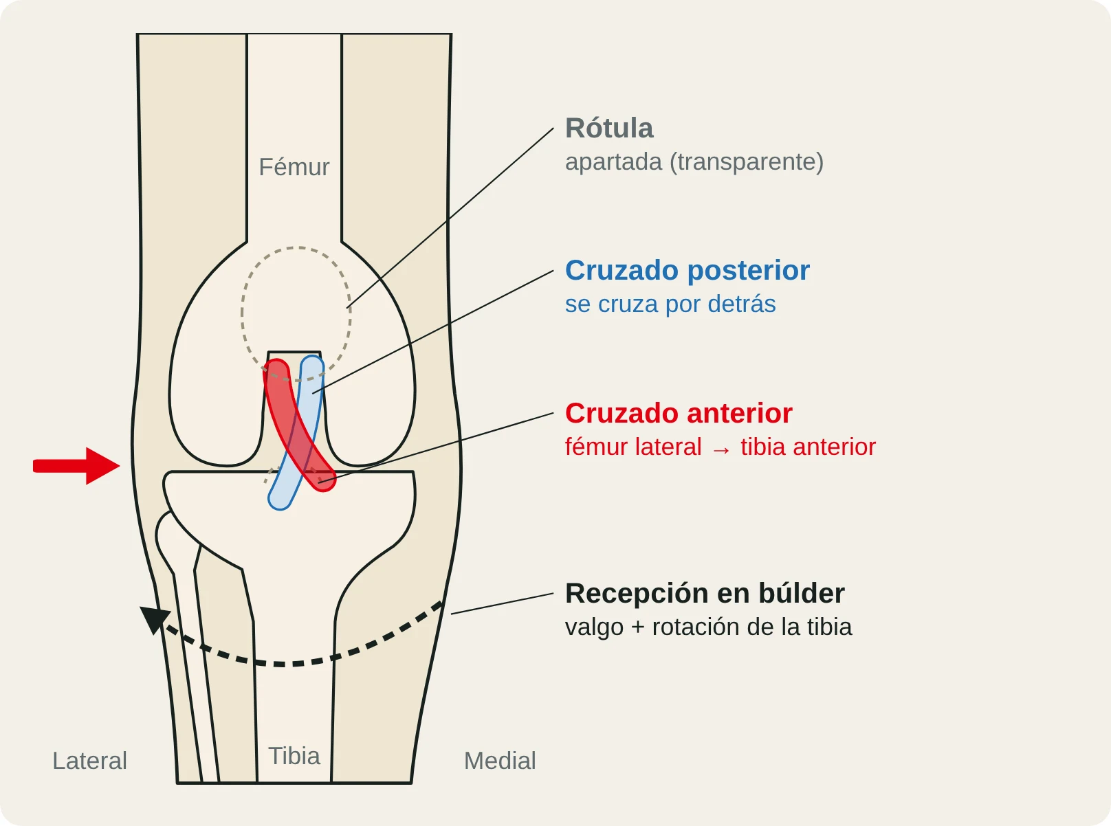 Vista frontal de la rodilla con el cruzado anterior y el posterior, y las fuerzas de valgo y rotación de una mala recepción en búlder.