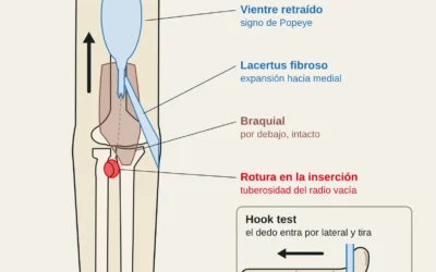 Rotura del tendón distal del bíceps en escalada: síntomas, cirugía y vuelta a escalar