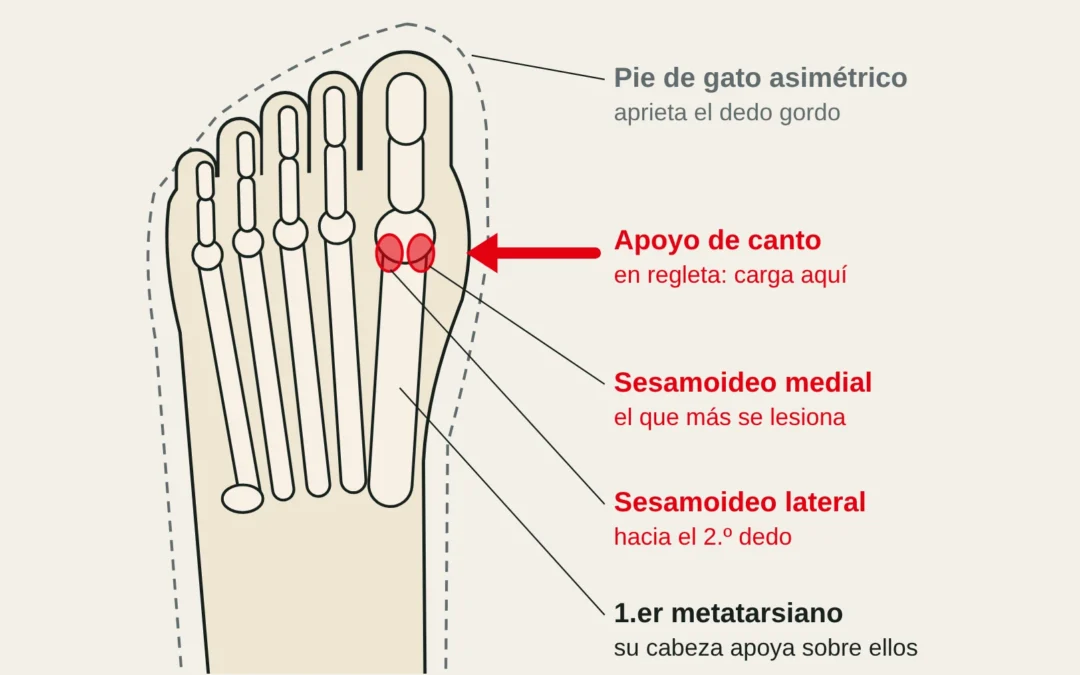 Vista plantar del antepié con los sesamoideos bajo la cabeza del 1.er metatarsiano, que cargan al apoyar de canto en una regleta.