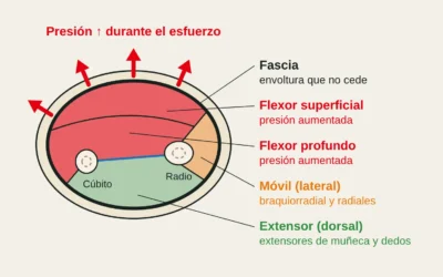 Síndrome compartimental del antebrazo en escalada: cuando el bombeo no es normal