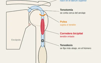 Tendinopatía del bíceps largo en escaladores: dolor delante del hombro, chasquidos y qué hacer